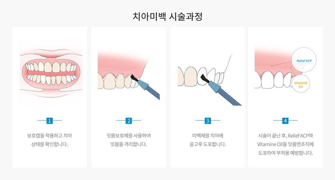 치아미백 시술과정