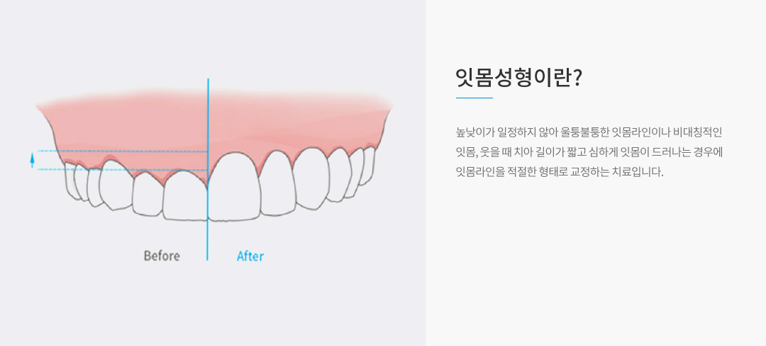 잇몸성형이란?