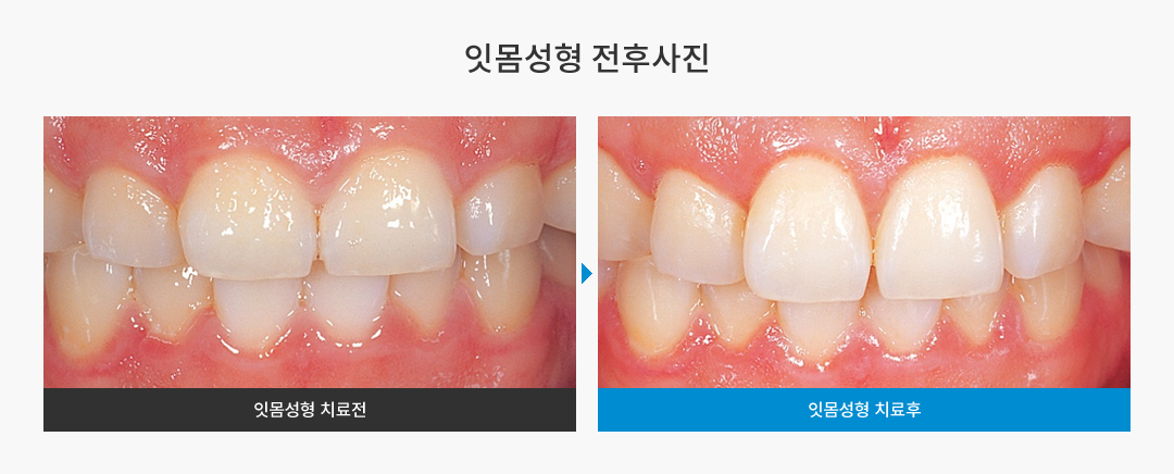 잇몸성형 전후사진