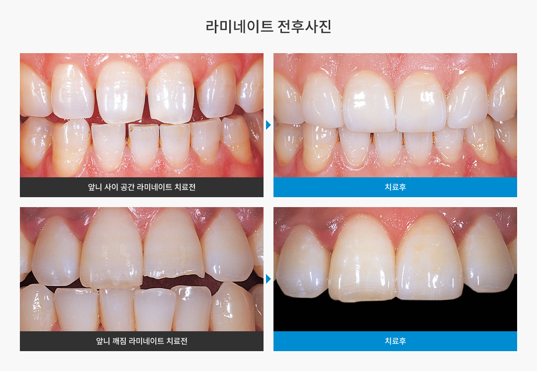 라미네이트 전후사진