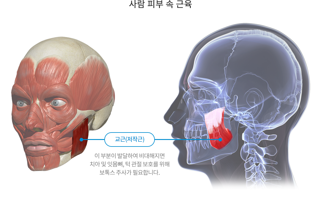 이 부분이 발달하여 비대해지면 치아 및 잇몸뼈, 턱 관절 보호를 위해 보톡스 주사가 필요합니다.