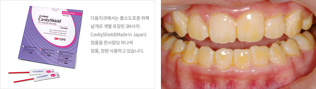 CavityShield 불소도포의약품