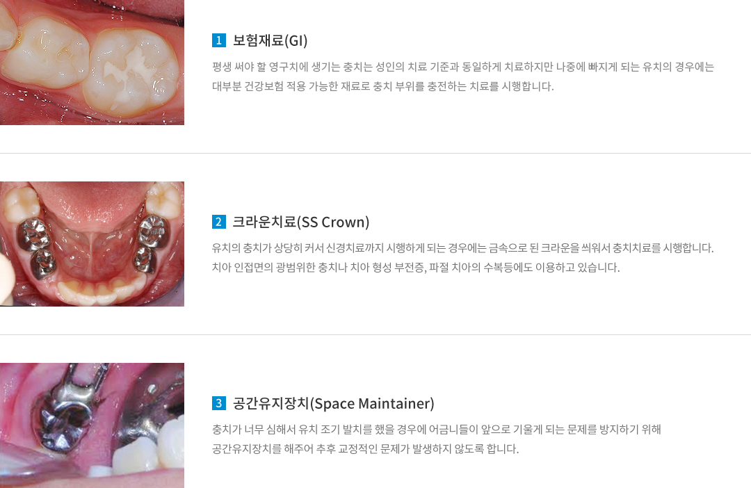 보험재료,크라운치료,공간유지장치