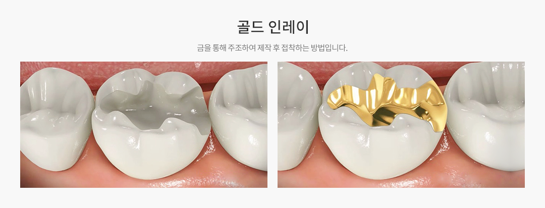 골드인레이