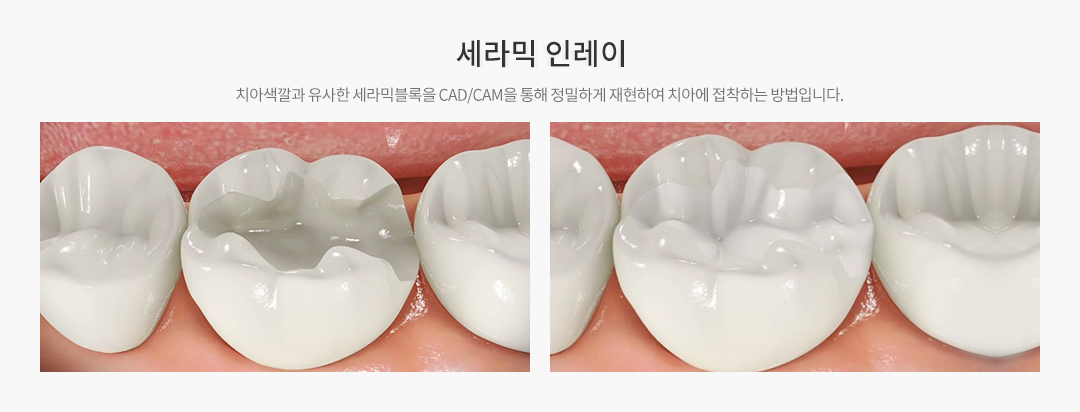 세라믹인레이