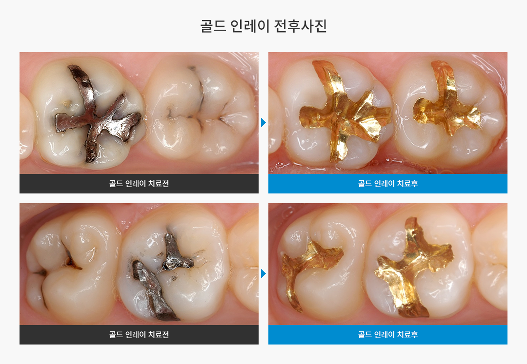 골드인레이 전후사진