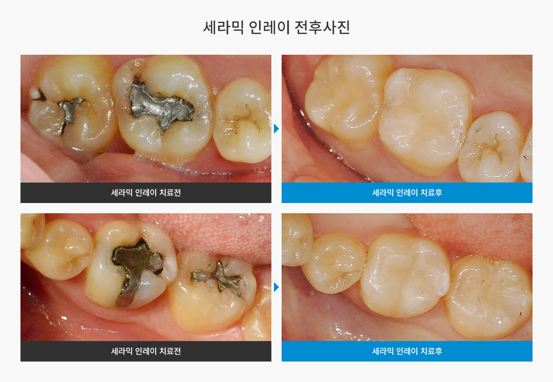 세라믹인레이 전후사진