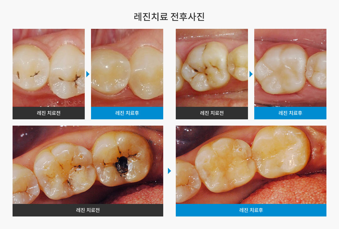 레진치료 전후사진