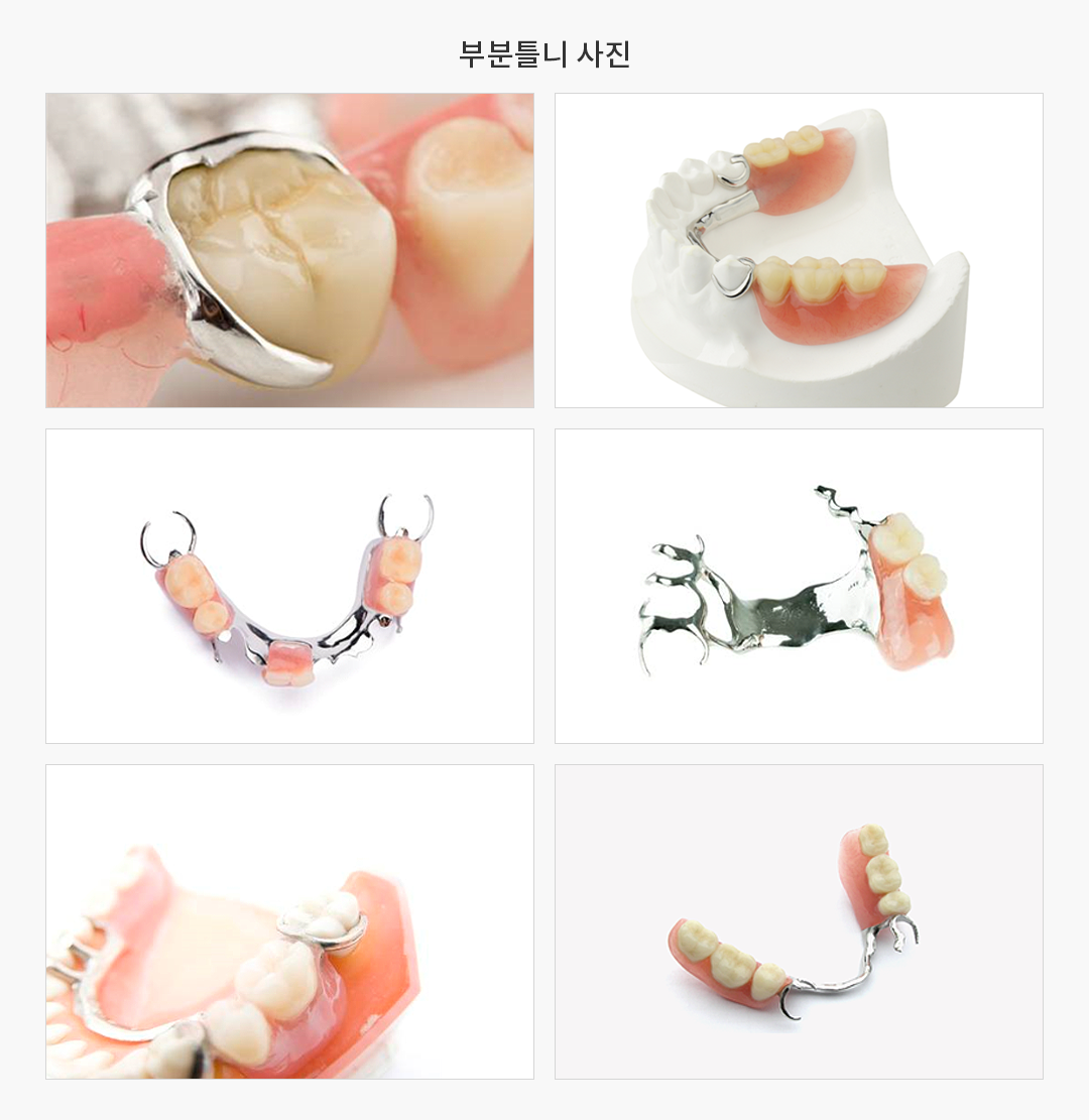 부분틀니 사진
