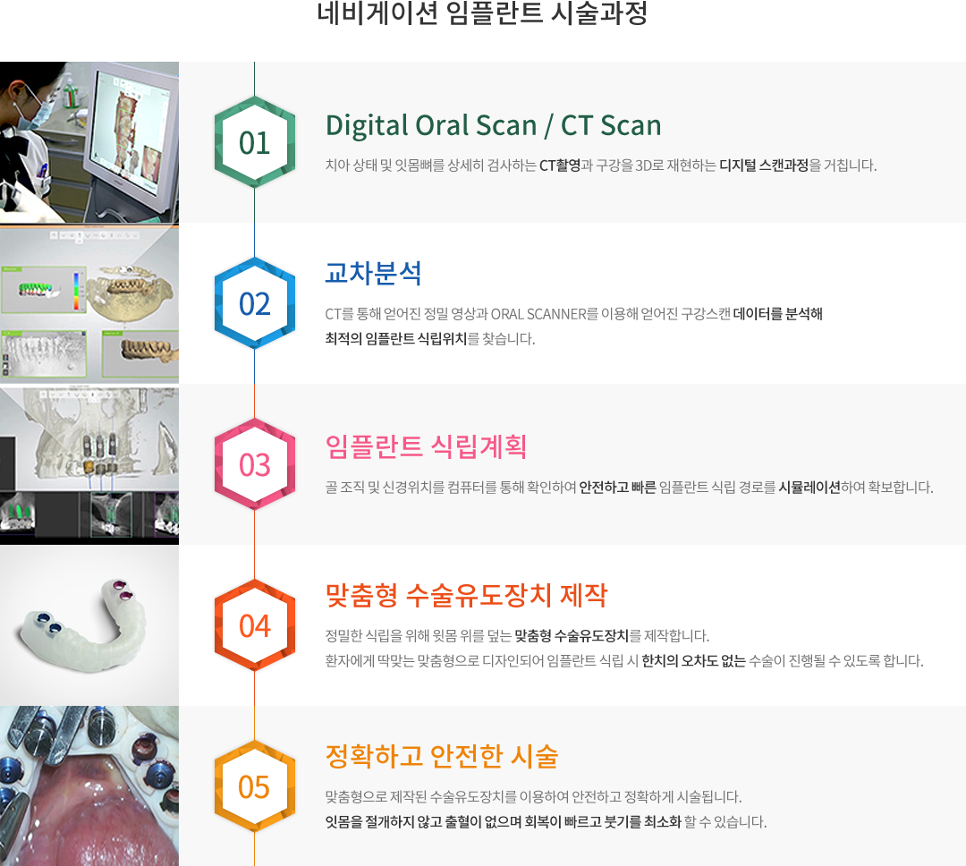 네비게이션 임플란트 시술과정 : 1.Digital Oral Scan/CT Scan 2.교차분석 3.임플란트 식립계획 4.맞춤형 수술유도장치제작 5.정확하고 안전한 시술