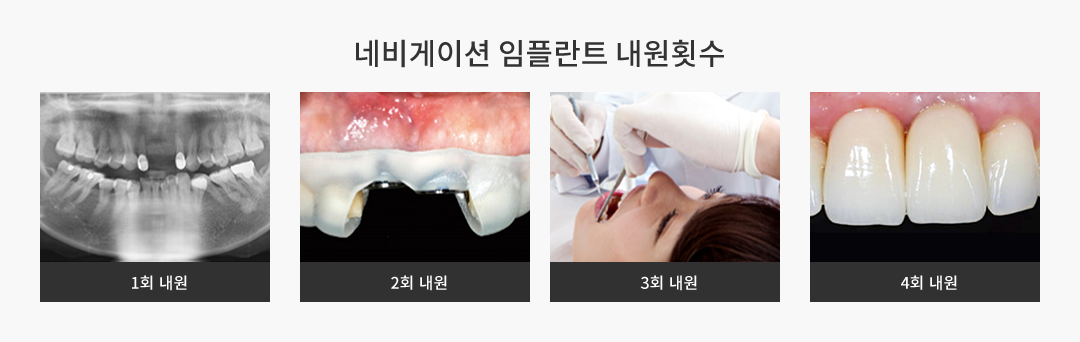네비게이션 임플란트 내원횟수