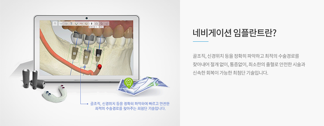 네비게이션 임플란트란? 골조직, 신경위치 등을 정확히 파악하고 최적의 수술경로를 찾아내 절개없이, 통증없이 최소한의 출혈로 안전한 시술과 신속한 회복이 가능한 최첨단 기술입니다.