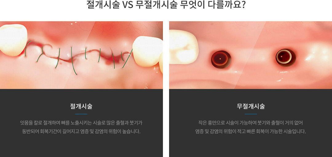 절개시술과 무절개시술의 차이 : 절개시술은 잇몸을 칼로 절개하여 뼈를 노출시키는 시술로 많은 출혈과 붓기가 동반되어 회복기간이 길어지고 염증 및 감염의 위험이 높습니다. 무절개시술은 작은 흉만으로 시술이 가능하여 붓기와 출혈이 거의 없어 염증 및 감염의 위험이 적고 빠른 회복이 가능한 시술입니다.