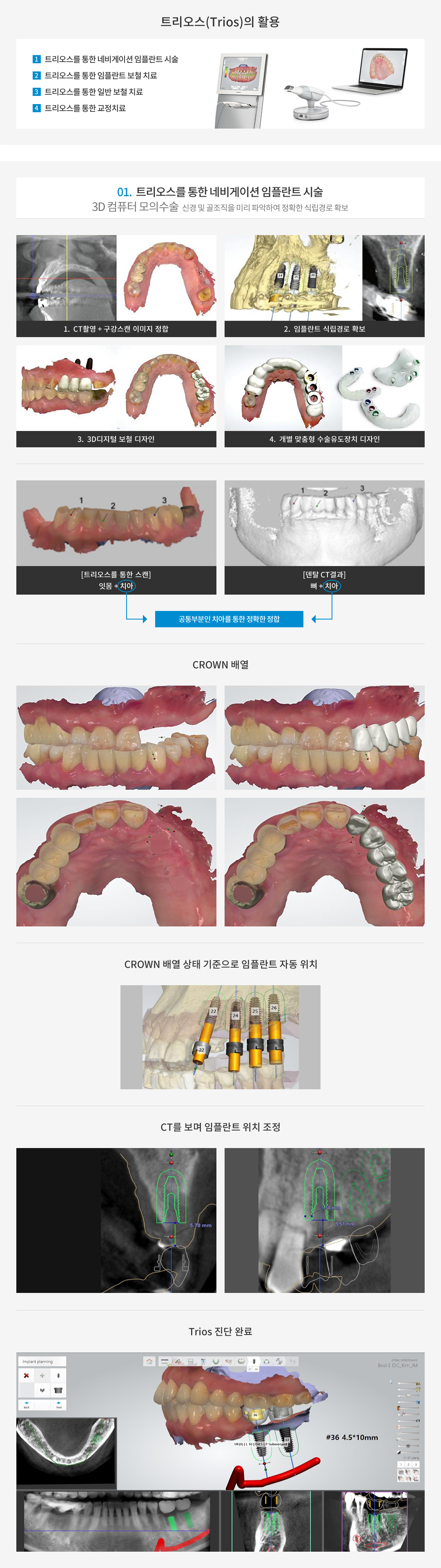 트리오스(Trios)의 활용 01. 트리오스를 통한 네비게이션 임플란트 시술