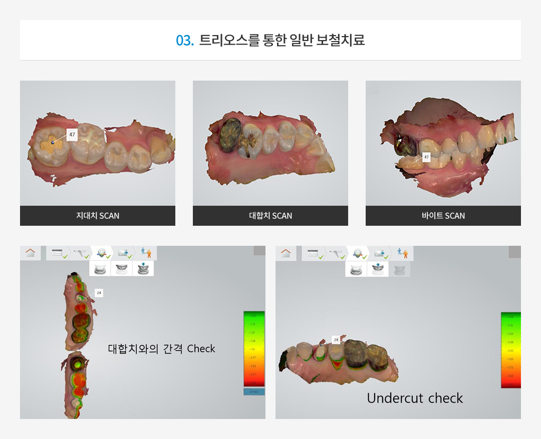03. 트리오스를 통한 일반 보철 치료