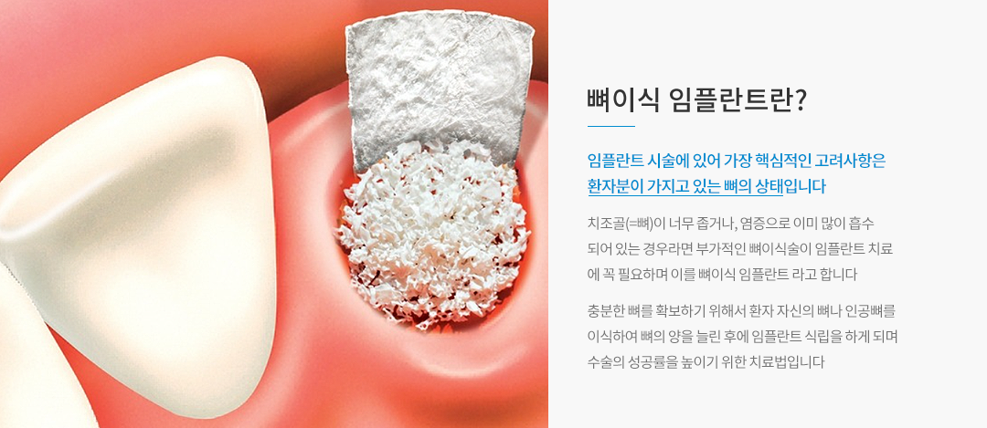 뼈이식 임플란트란?