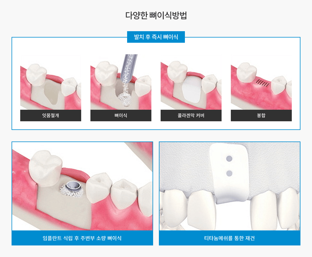 다양한 뼈이식방법