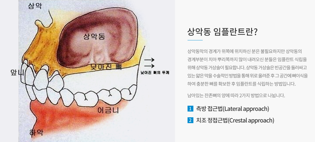 상악동 임플란트란?