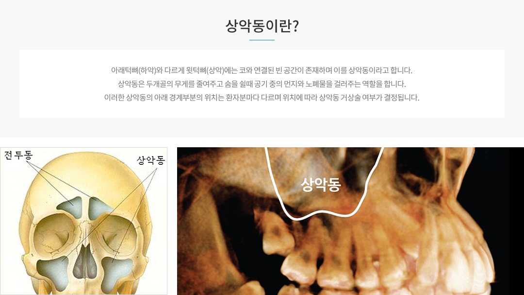상악동이란?