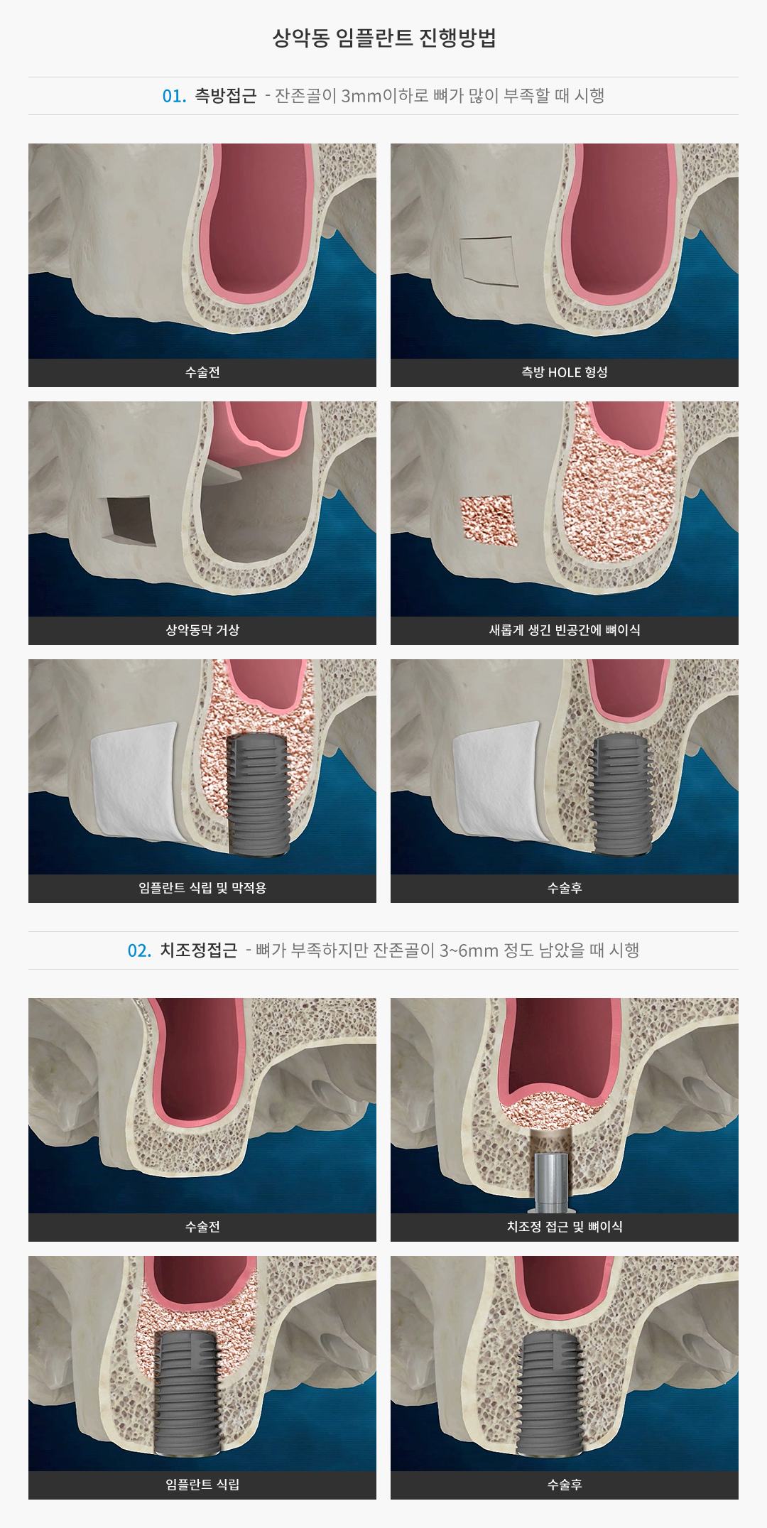상악동 임플란트 진행방법