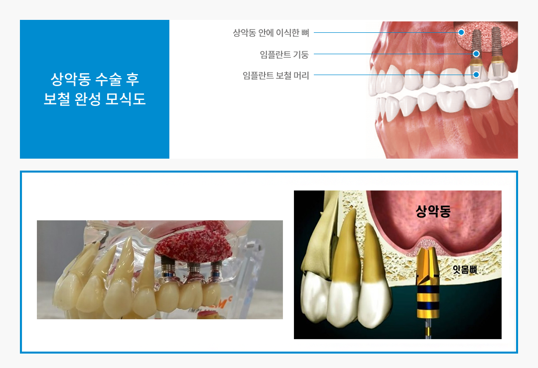 상악동 수술 후 보철 완성 모식도