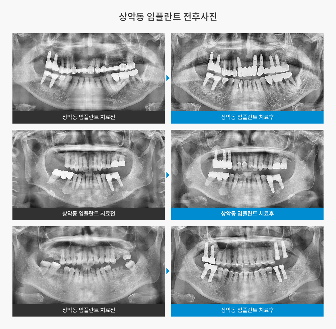 상악동 임플란트 전후사진