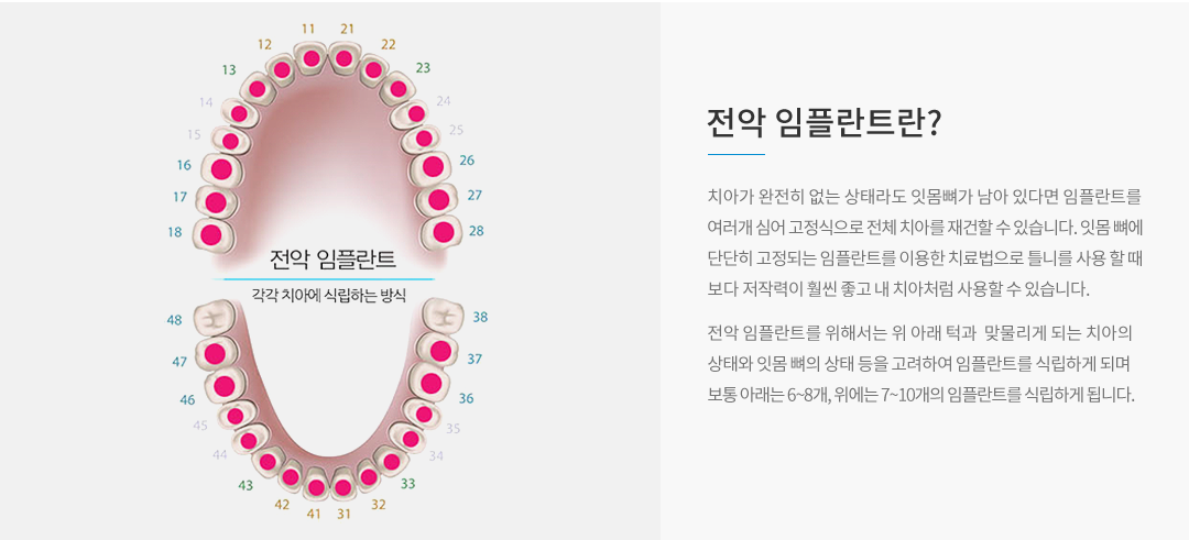전악 임플란트란?
