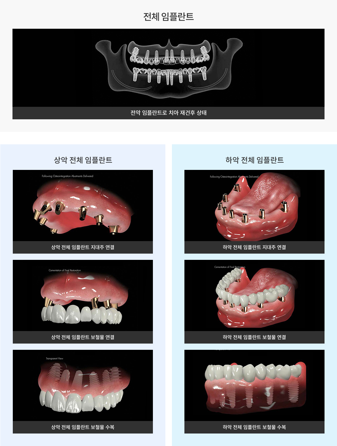 전체 임플란트