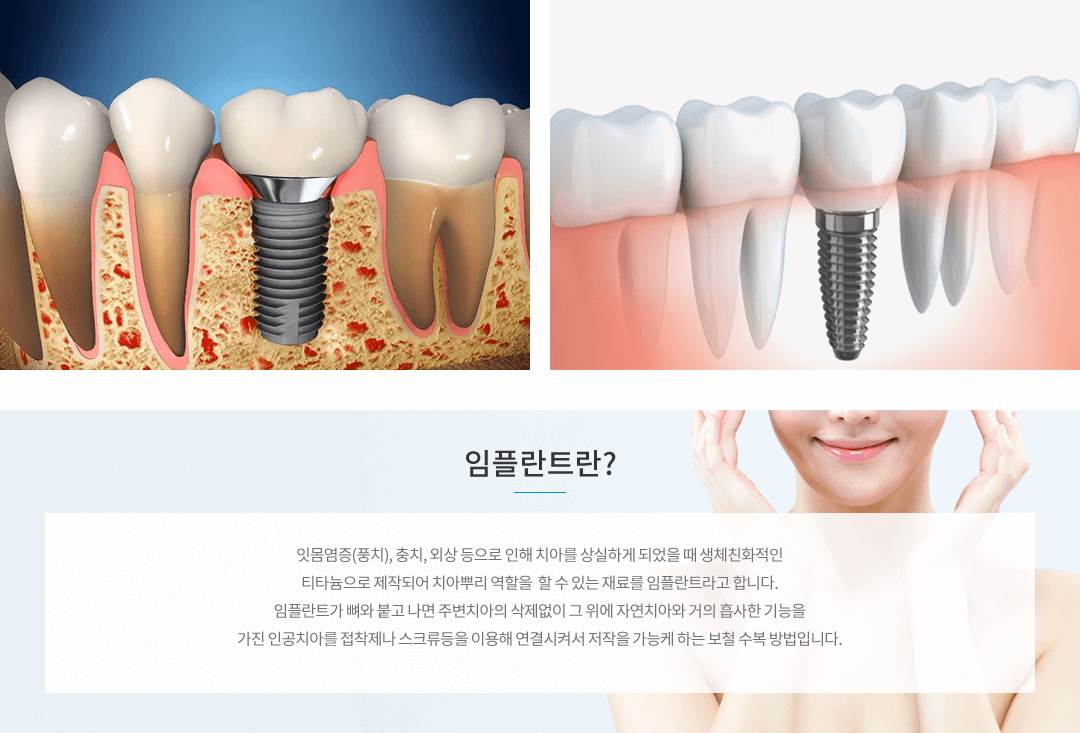 임플란트란? 잇몸염증(풍치), 충치, 외상 등으로 인해 치아를 상실하게 되었을 때 생체친화적인 티타늄으로 제작되어 치아뿌리 역할을 할 수 있는 재료를 임플란트라고 합니다. 임플란트가 뼈와 붙고 나면 주변치아의 삭제없이 그 위에 자연치아와 거의 흡사한 기능을 가진 인공치아를 접착제나 스크류등을 이용해 연결시켜서 저작을 가능케 하는 보철 수복 방법입니니다.