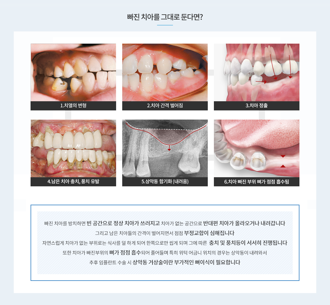 빠진 치아를 그대로 둔다면? 치열의 변형, 치아 간격 벌어짐, 충치및 풍치 유발, 나이들어 보이는 인상, 오랜 방치시 잇몸뼈 흡수됨, 음식물 씹기 어려워 소화기능 저하