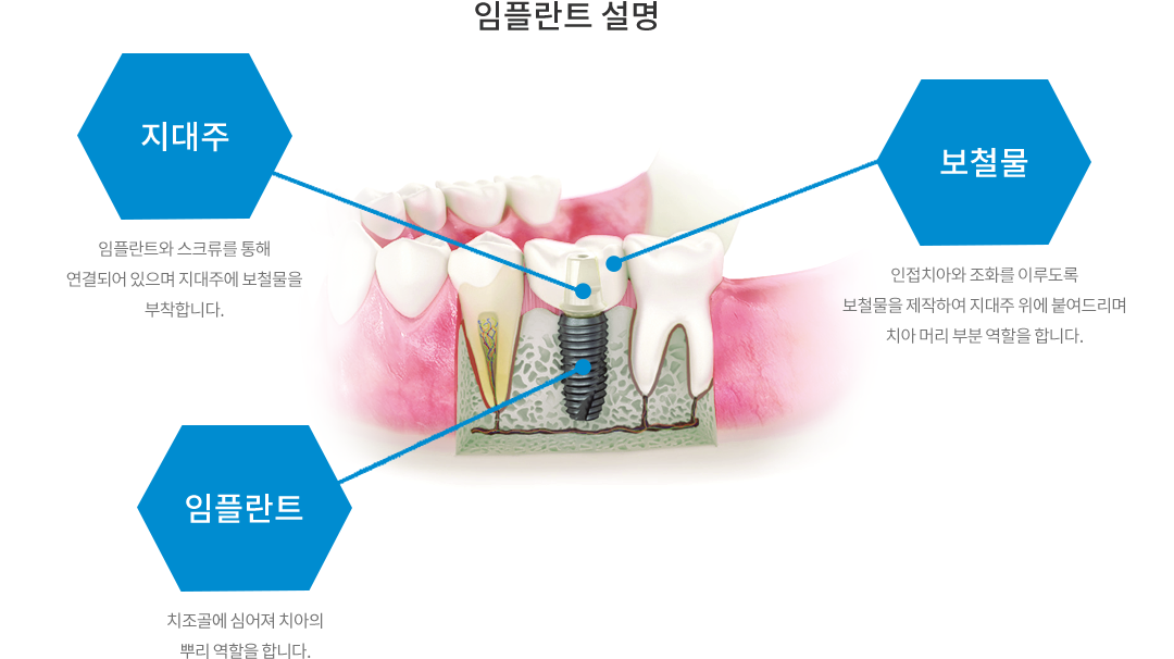 임플란트 설명
