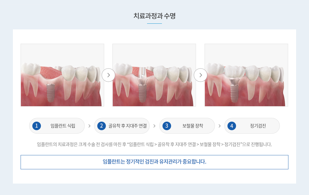 임플란트 치료과정과 수명 : 1.진단 2.식립 3.2차시술 4.보철 순의 과정이며, 반영구적이라 하더라도 본인 스스로 정기검진과 사후관리를 철저히 해야만 장기적인 수명을 보장합니다.