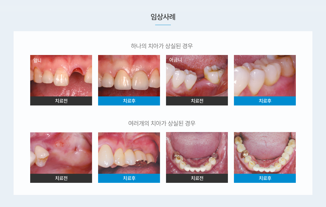 임플란트 임상사례 치료전후 사진