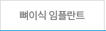 뼈이식 임플란트