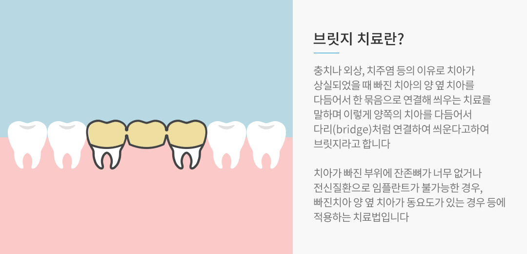 브릿지치료란?