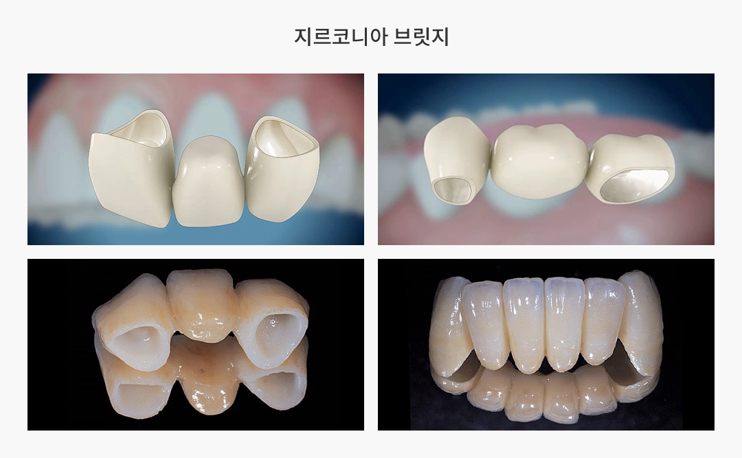 지르코니아 브릿지