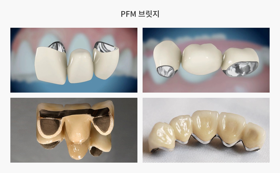 PFM 브릿지