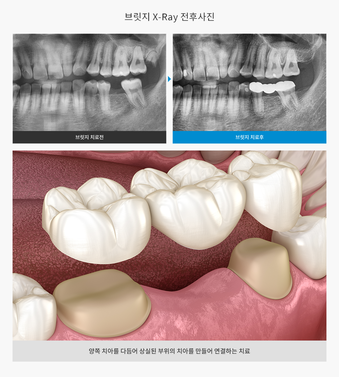 브릿지 X-Ray 전후사진