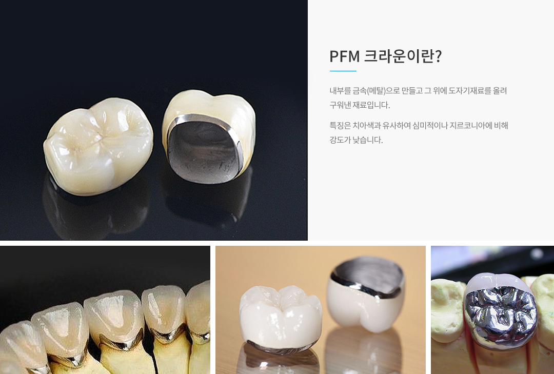 PFM 크라운이란?