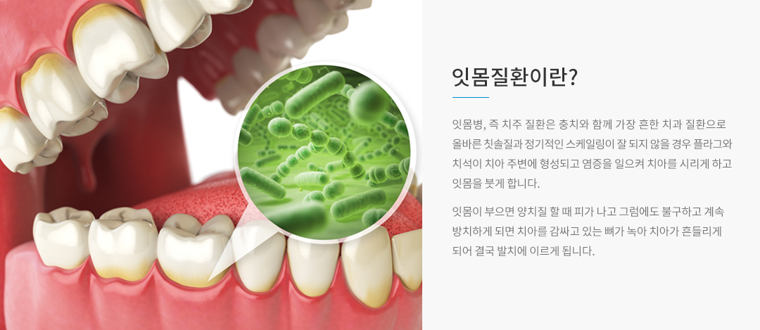 잇몸질환이란? 잇몸병, 즉, 치주 질환은 충치와 함게 가장 흔한 치과 질환으로 올바른 칫솔질과 정기적인 스케일링이 잘 되지 않을 경우 플러그와 치석이 치아 주변에 형성되고 염증을 일으켜 치아를 시리게 하고 잇몸을 붓게 합니다. 잇몸이 부으면 양치질할 때 피가 나게 되고 그럼에도 불구하고 계속 방치하게 되면 치아를 감싸고 있는 뼈가 녹아서 치아가 흔들리게 되며 결국 발치에 이르게 됩니다.
