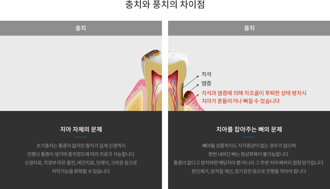 충치와 풍치의 차이점 : 충치는 치아 자체의 문제이며, 초기 충치는 통증이 없지만 신경까지 진행시 통증이 있고, 원상회복이 가능합니다. 레진, 인레이, 크라운 등으로 진행을 막을수만 있습니다. 풍치는 치아가 아닌 치아를 잡아주는 뼈의 문제이며, 빼야 될 상황까지도 증상이 없는 경우도 많으며 원상회복이 불가능합니다. 원인제거, 양치질 개선, 정기검진 등으로 진행을 막을수만 있습니다.
