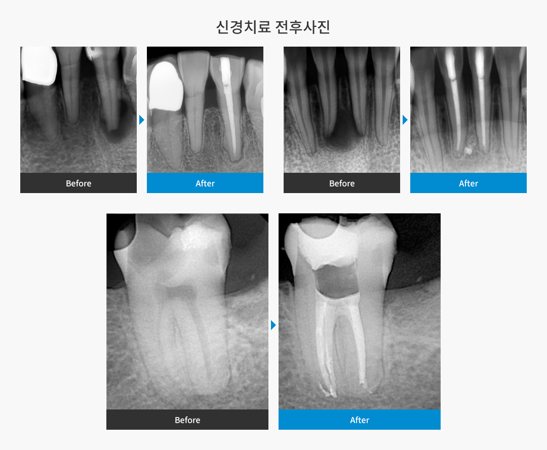 신경치료 전후사진