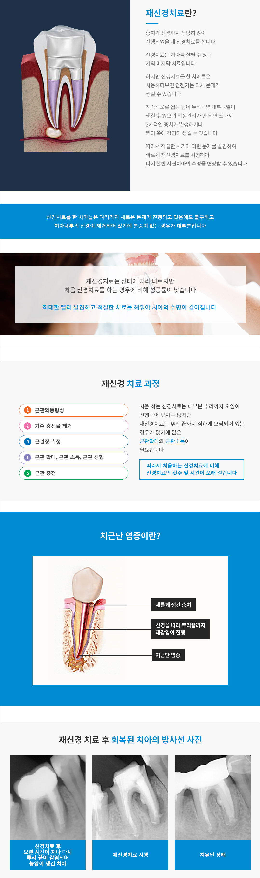 재신경치료