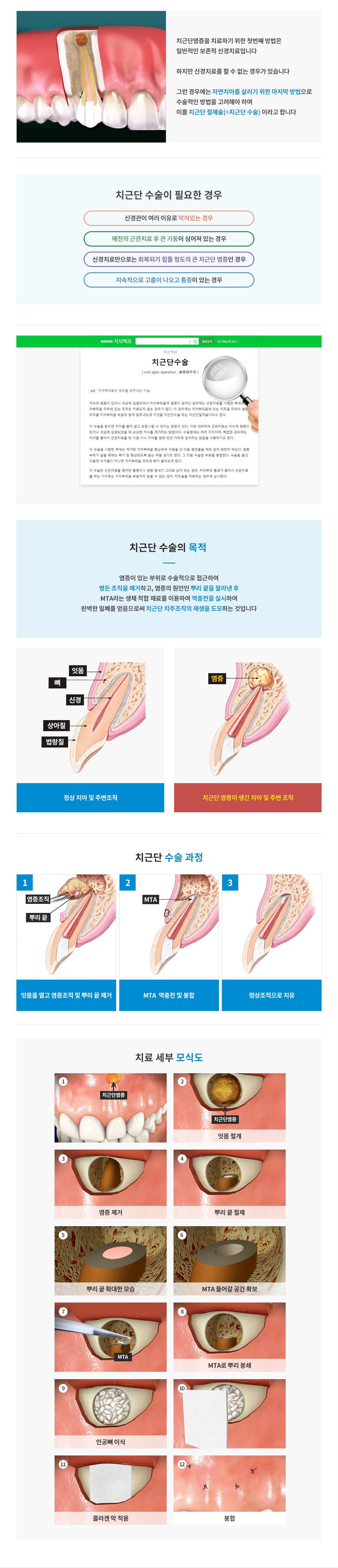 치근단수술