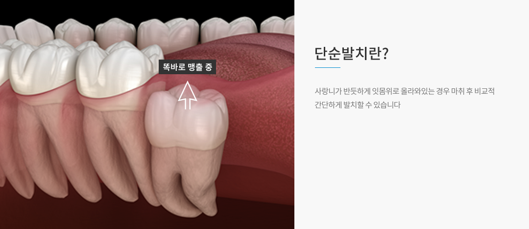단순발치란?