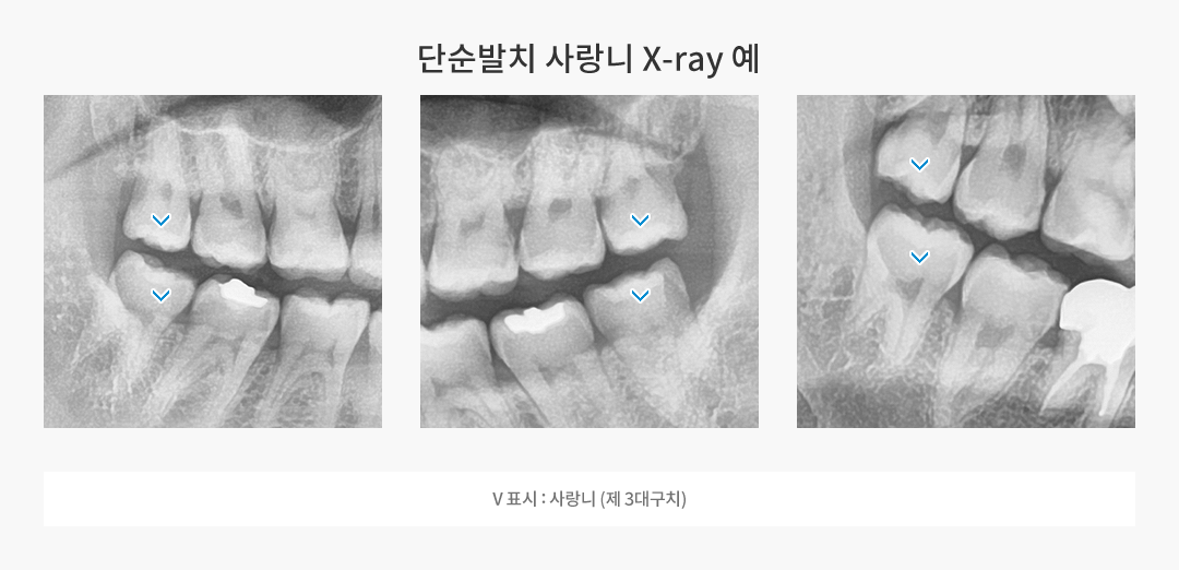 단순발치 사랑니 X-Ray 예