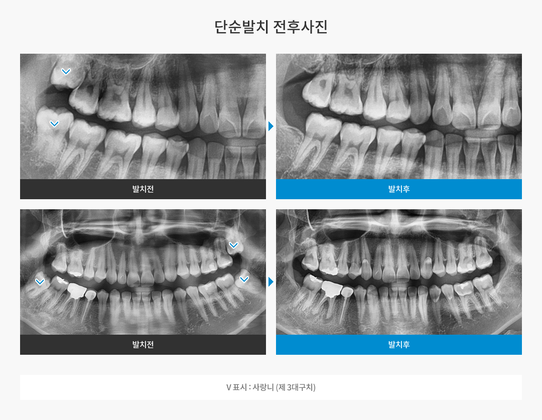 단순발치 전후사진