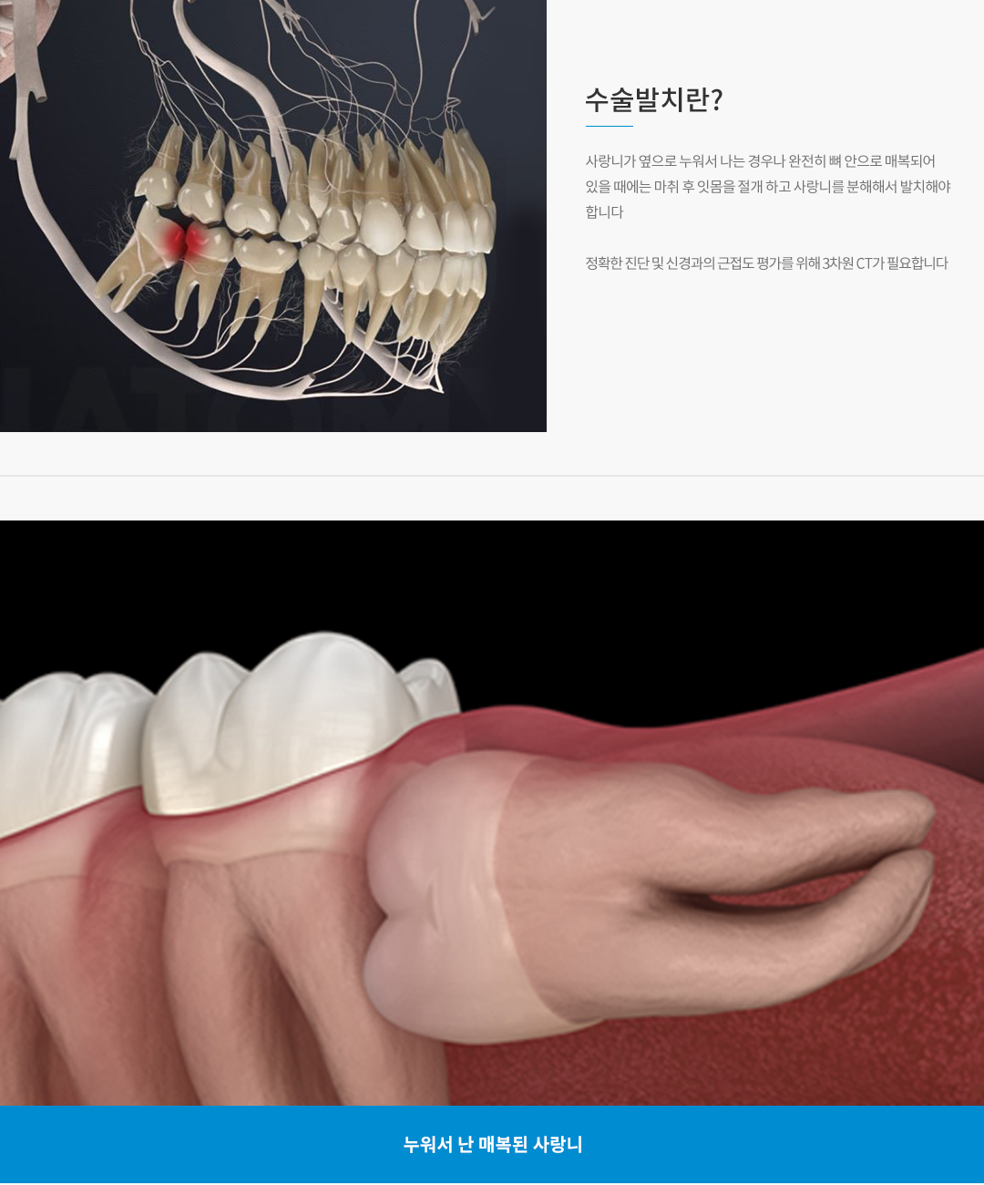 수술발치란?