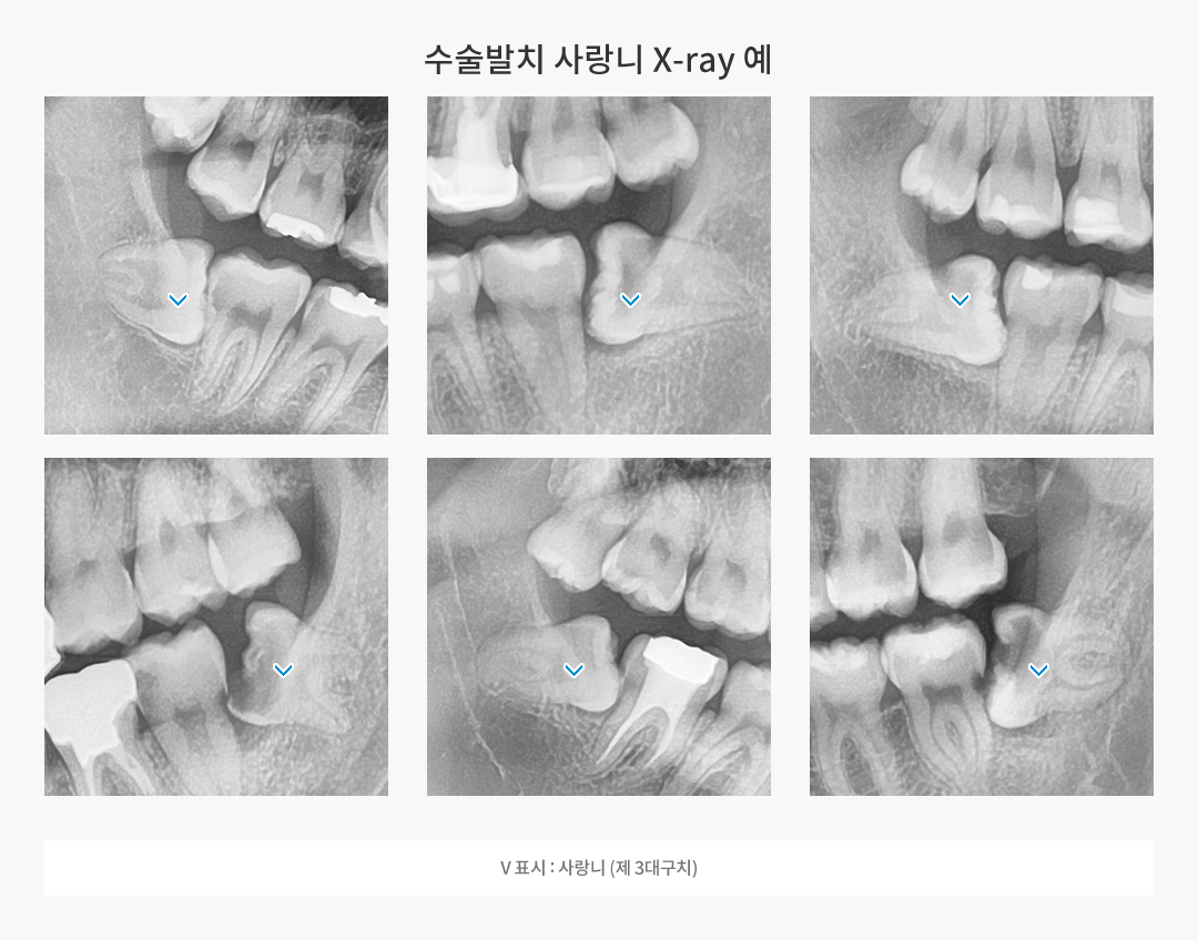 수술발치 사랑니 X-Ray 예